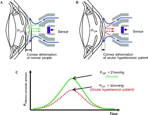 New Tonometry: The Search for True IOP 